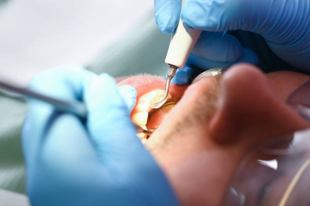 Best Knocked-Out Tooth (Avulsed Tooth) Treatment in Camanche, IA