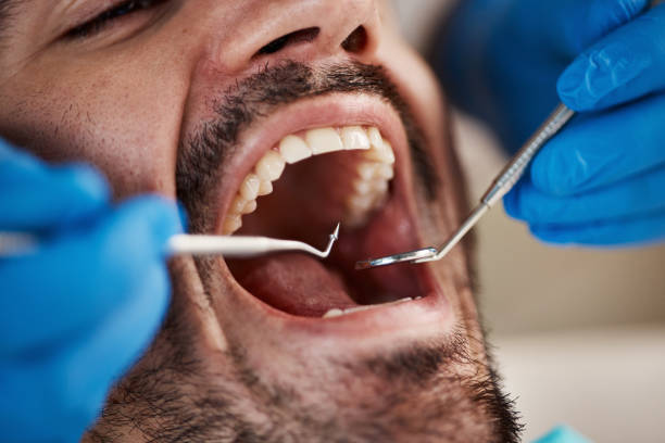 Best Knocked-Out Tooth (Avulsed Tooth) Treatment in Camanche, IA